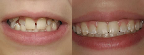 Orthodontic treatment