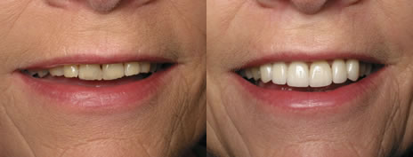 Porcelain veneers