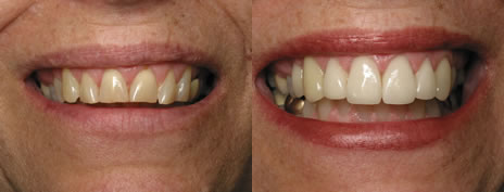 Porcelain veneers