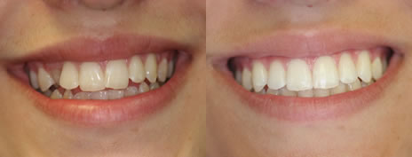 Orthodontic treatment