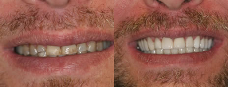 Full-mouth rehabilitation with crowns