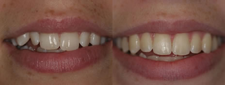 Orthodontic treatment