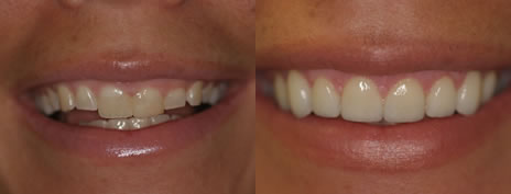 Porcelain veneers